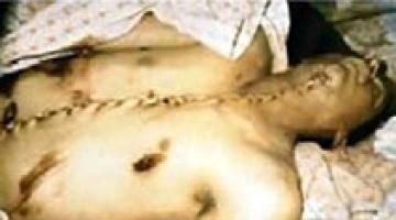 في تسعينات القرن الماضي .. قرنيات الشهداء الفلسطينيين تنزع لصالح الجنود الصهاينة