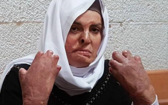 الأسيرة إسراء جعابيص في وضع صحي خطير للغاية