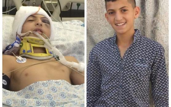إصابة مقدسي بعيار مطاطي برأسه بالعيسوية